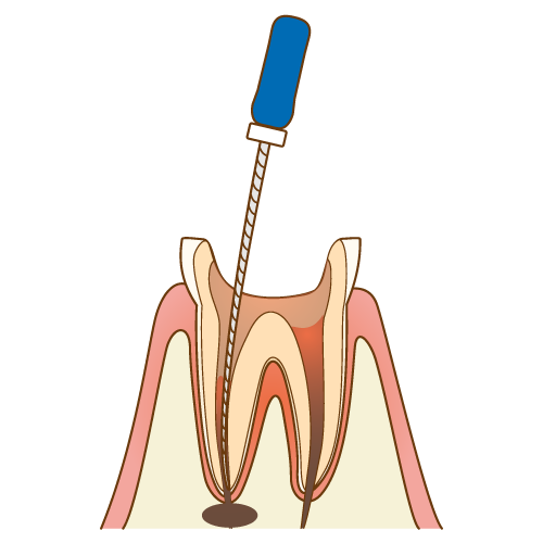 歯の神経を取り除く