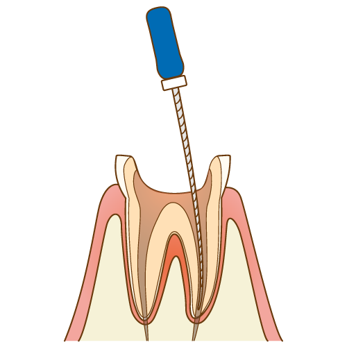根管を拡大