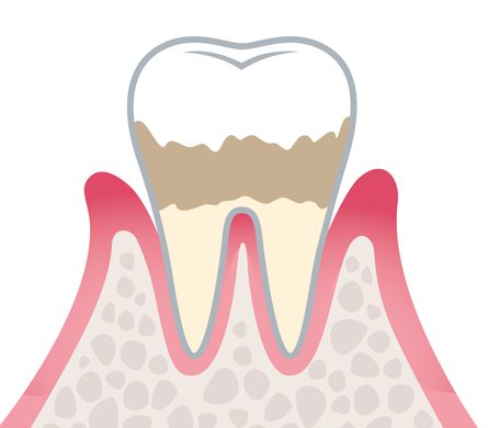 軽度歯周炎